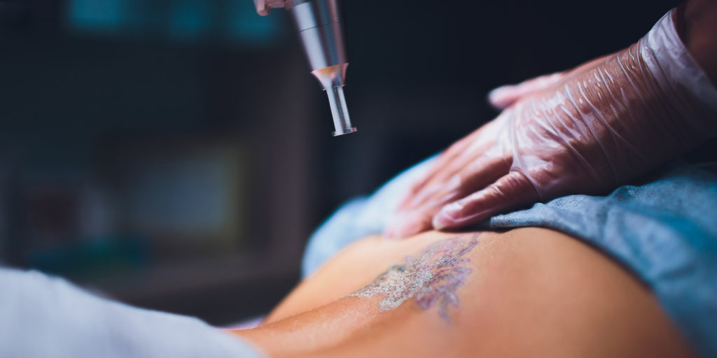 Connecticut Tattoo Removal Center